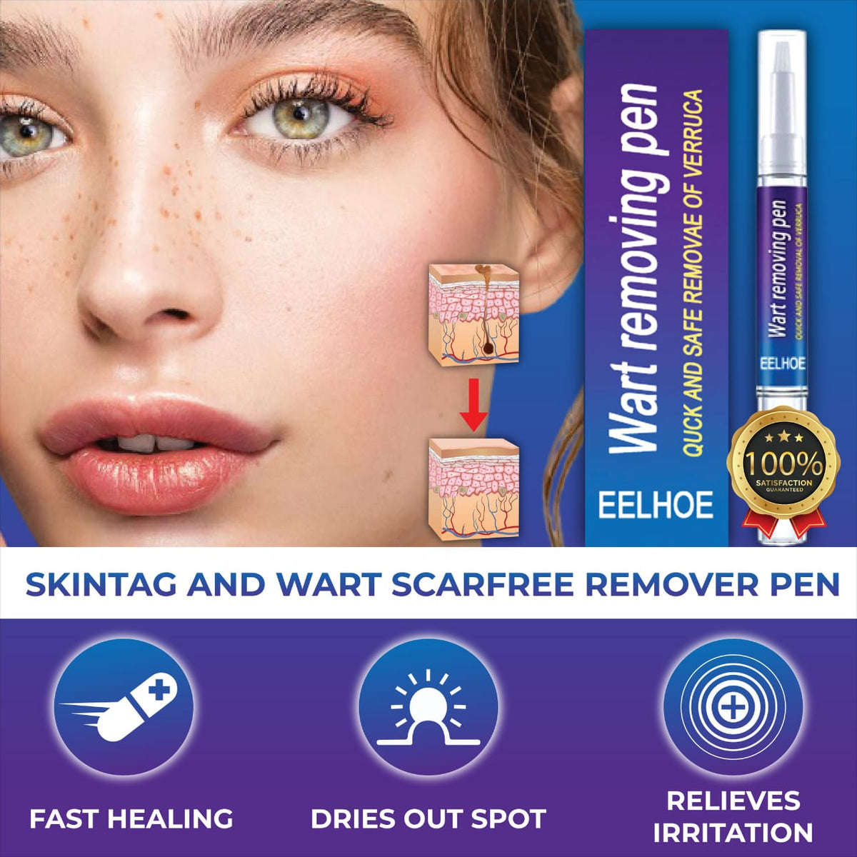 Warts Remover Gel Pen