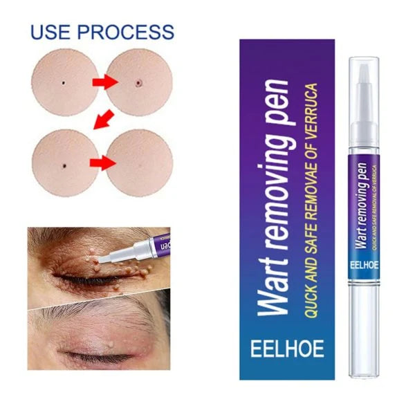 Warts Remover Gel Pen