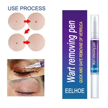Warts Remover Gel Pen